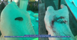 A leech on my wrist in Malaysian Borneo. Look at the mess it made when removed! The anticoagulant makes things look much worse than they are. 